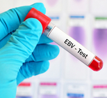 מחלת הנשיקה: מדריך-תמונה